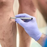 A surgeon wearing blue gloves is marking veins on a person's leg using a surgical skin marker pen