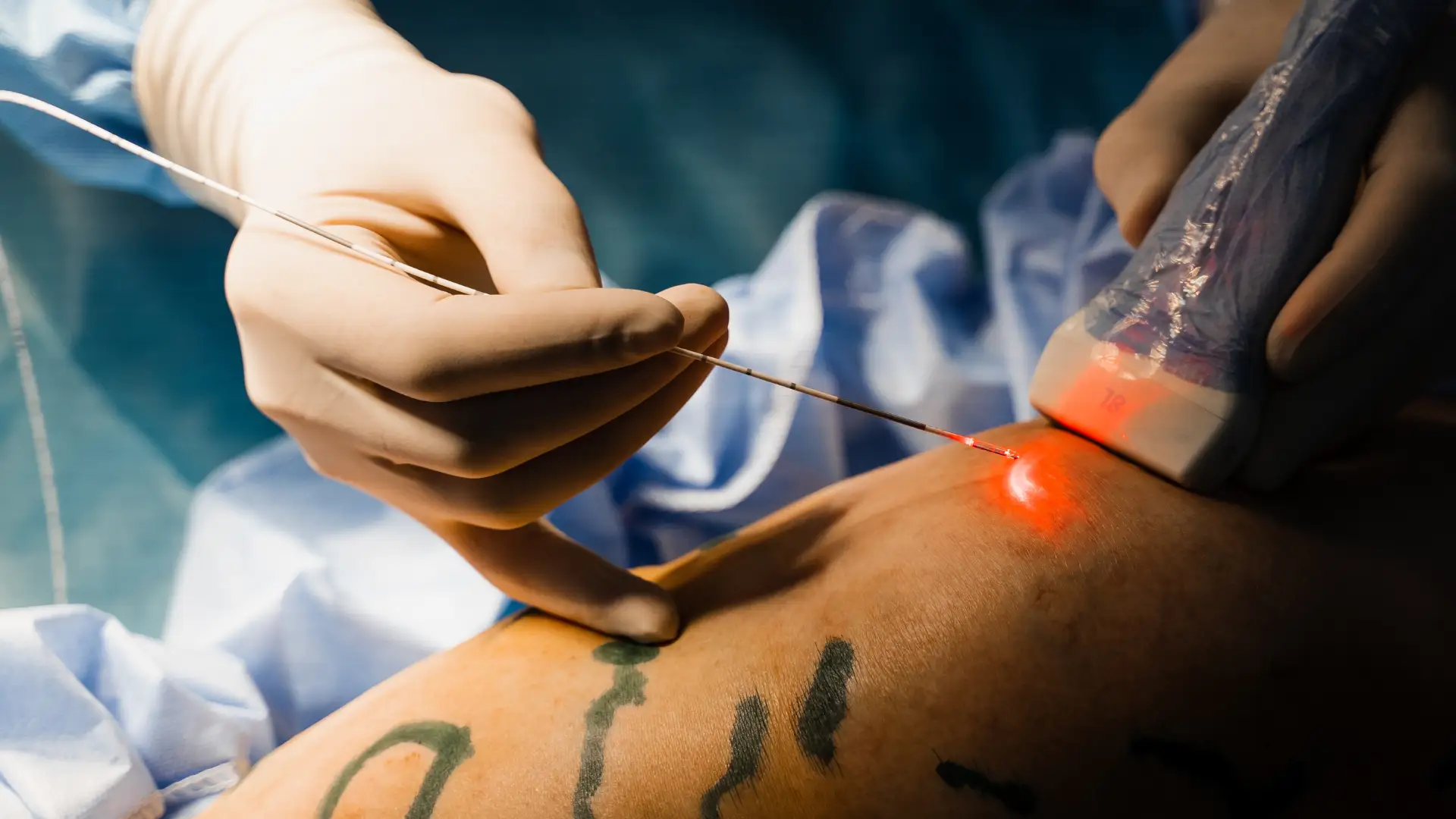 a doctor is using a EVLT red laser on a patient's leg